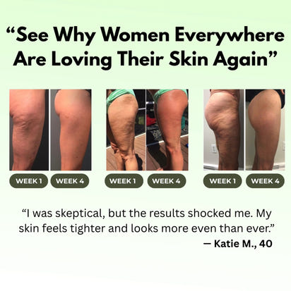 SculptEase Cupping Cellulite Massager™